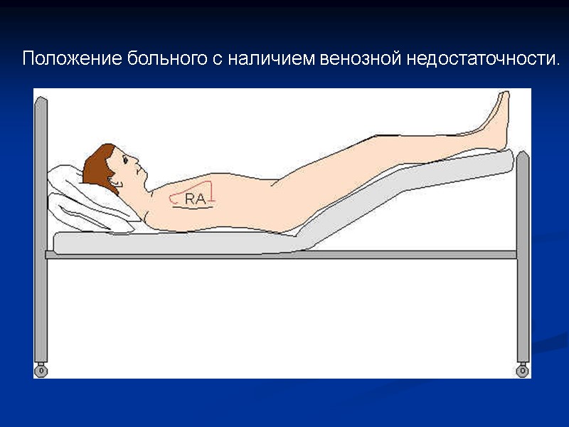 Положение больного с наличием венозной недостаточности.